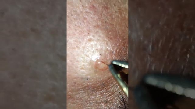 ازالة شعرة نابتة تحت الجلد /تسببت في التهاب /تصوير تحت المجهر /سبحان الله #جدة #الرياض