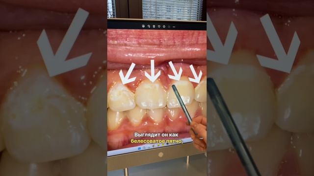 🦷 Какие бывают виды кариеса?
