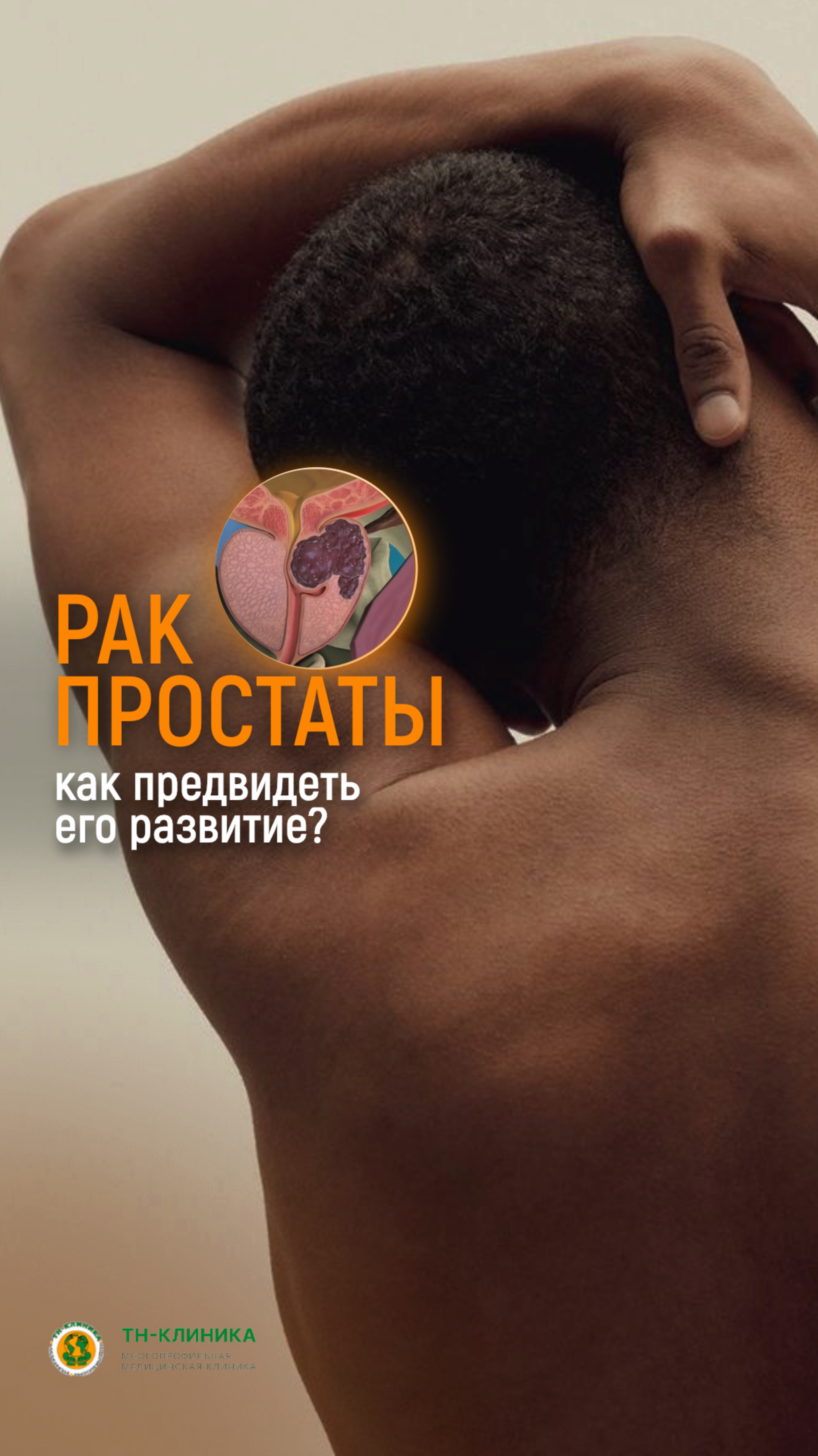 Рак простаты, как вовремя диагностировать?