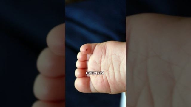 Родинки у детей.
