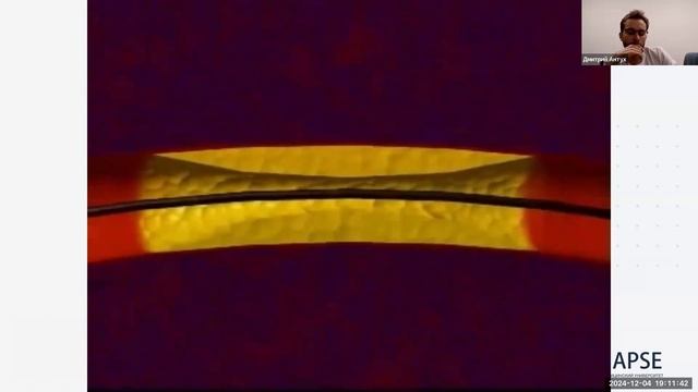 ИБС - ишемические заболевания сердца ОКС