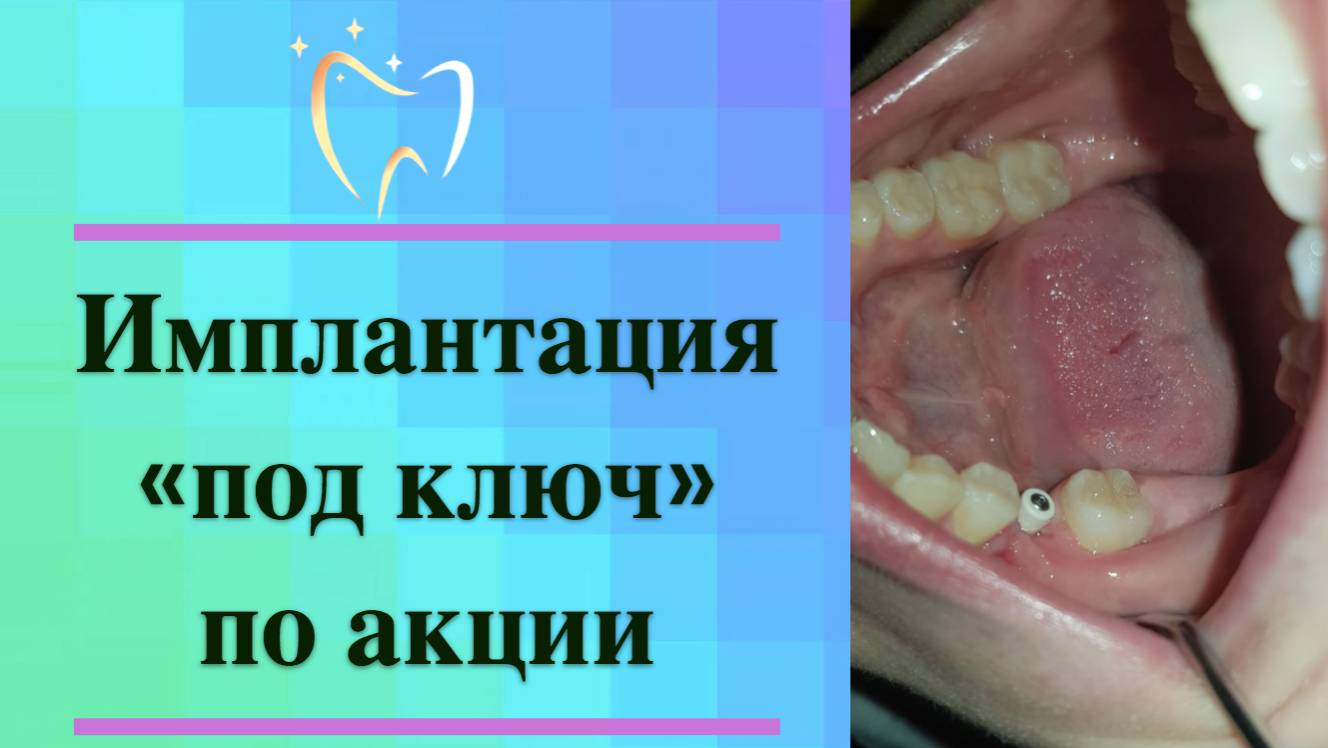 Имплантация под ключ по акции