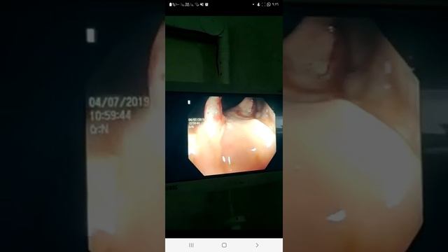 Dieulafoy in descending  colon| treat by epinephrine injection then banding or clipping| Colonoscop
