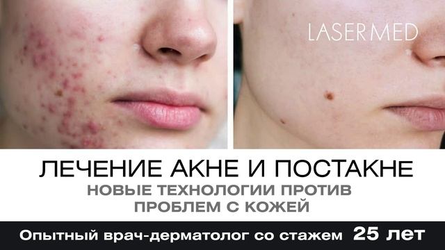 Клиника Lasermed Лечение Акне