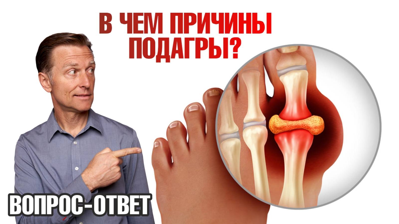 Приступы подагры. Альтернативный взгляд на причины подагры🧐