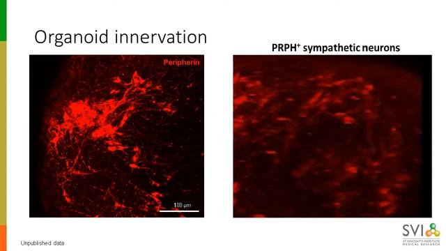 Heart disease in a dish: Human iPSC-derived multicellular cardiac organoids
