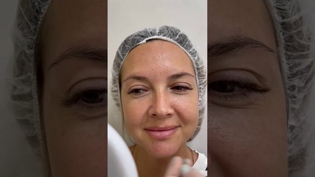 Контурная пластика скул. Видео 1