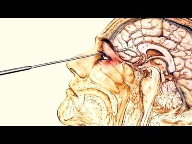 Yung Forest - Lobotomy (OFFICIAL LYRIC VIDEO) [prod.FLAWLESS]