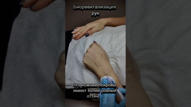 биоревитализация рук #косметология #красотакожи #красотарук #заботаосебе