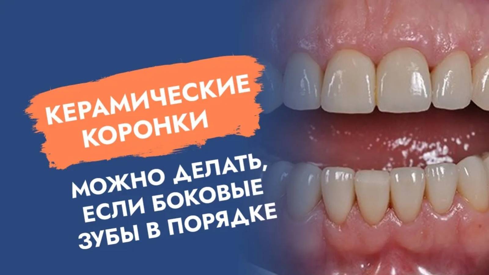 Никогда не делайте керамические коронки и виниры, пока не ...