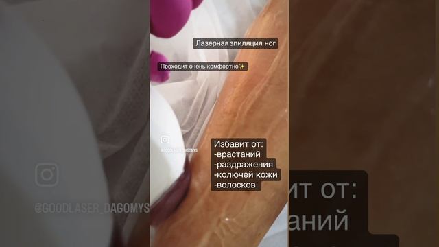 Лазерная эпиляция ноги