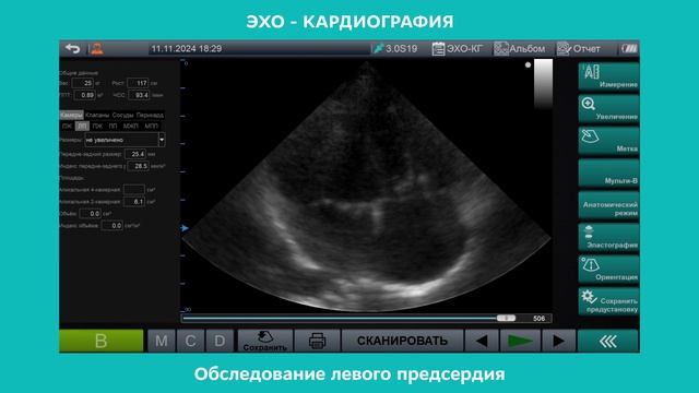 ЭХО - КАРДИОГРАФИЯ