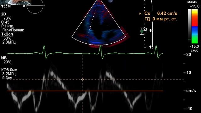 ЭХОКГ . Снижен GLS