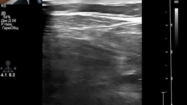 УЗИ артерий нижних конечностей при боли и судорогах, в чем причина? Есть ишемия?