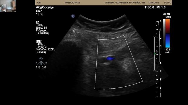 УЗИ вен ног после операции по замене тазобедренного сустава