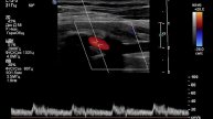 УЗИ БЦА . Латентный стил синдром. Как выявить, если кровоток в позвоночной антеградный?