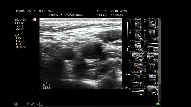 УЗИ БЦА ( УЗИ сонных артерий ) 2020 06 29 10 46 20