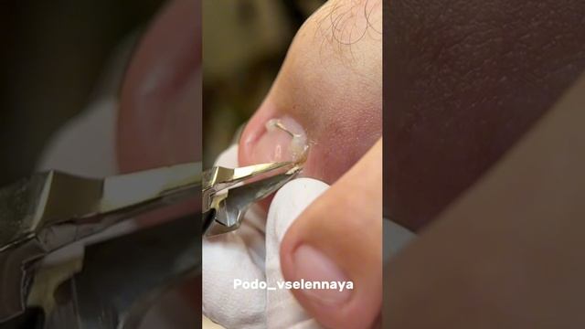 Вросший ноготь после хирурга.