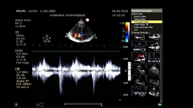 ЭХОКАРДИОГРАФИЯ 2020 06 30 14 05 17