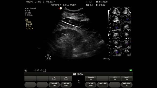 УЗИ сосудов почек норма 2020 06 16 11 21 30