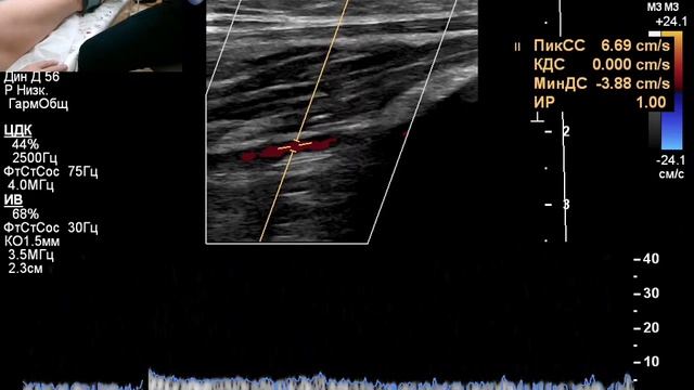 УЗИ сосудов. Определение ЛПИ ( лодыжечно-плечевой индекс)