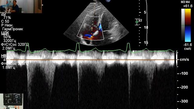 ЭХОКГ в Уссурийске: порок сердца: митральный стеноз