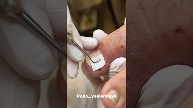 Врос ноготь.