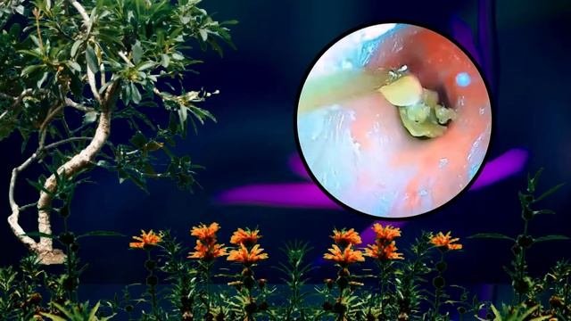 Tympanic Membrane Perforation And Postoperative Debridement For Cholesteatoma #137