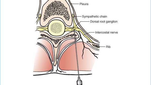 Paravertebral block and mid-transverse process pleura block