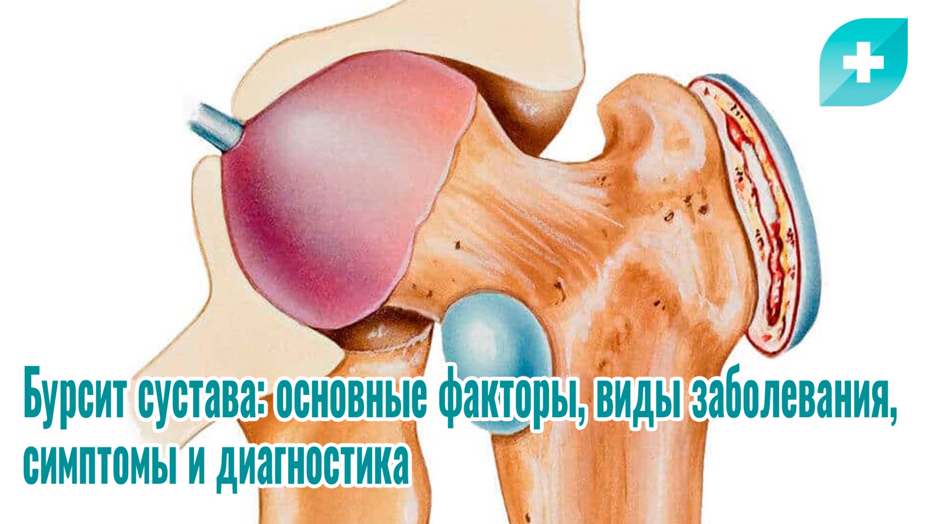 Бурсит сустава: основные факторы, виды заболевания, симптомы и диагностика