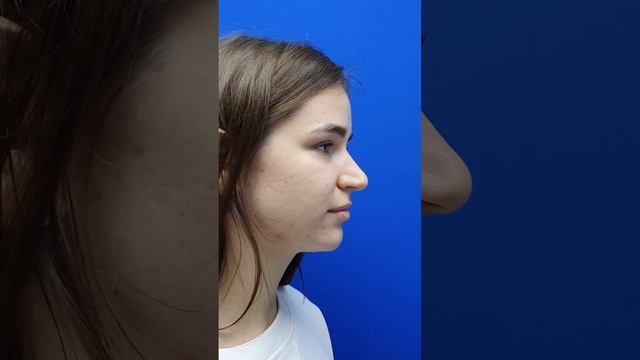 Отдалённый результат ринопластики.
До и 2 года спустя