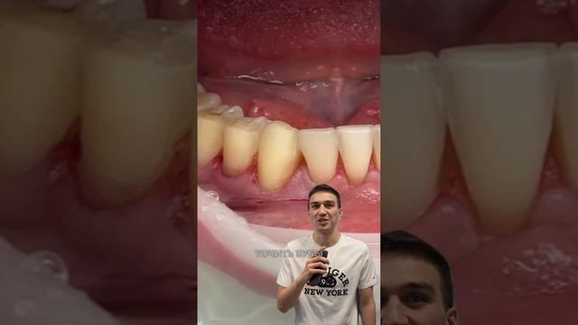 Обточка под виниры