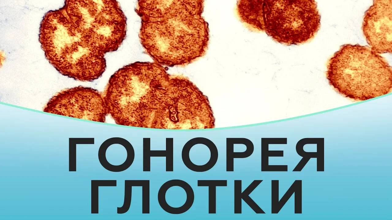 Гонорея горла. Диагностика гонореи горла. Лечение гонореи горла