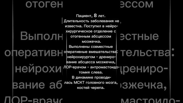 МСКТ височных костей после антромастоидотомии слева, дренирования абсцесса мозжечка