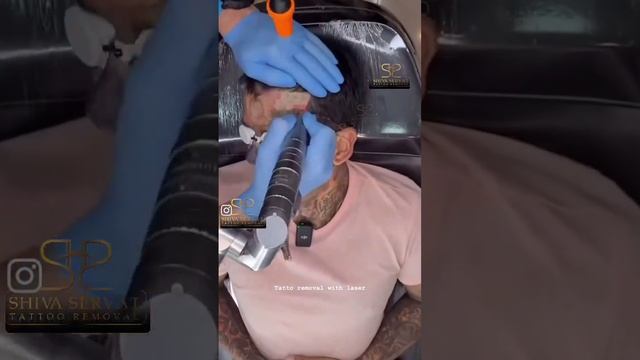 Лазерное удаление татуировок.
📹 shivaservat