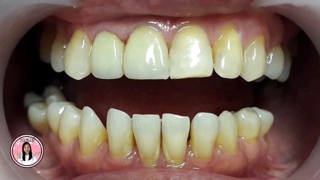 Before and after : ceramic and zirconia crowns for discolored teeth