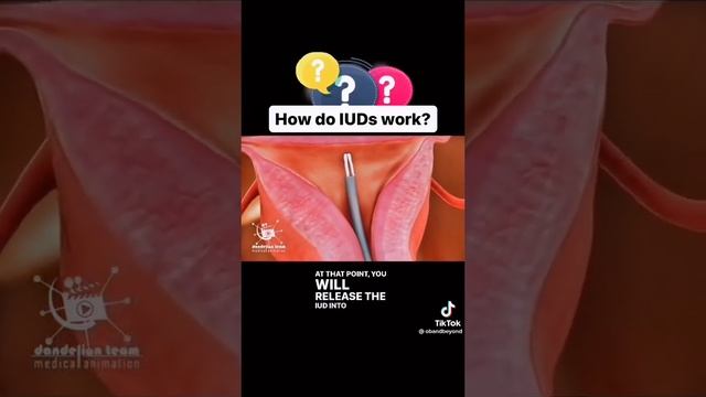 How IUD works | Birth control| Female health
