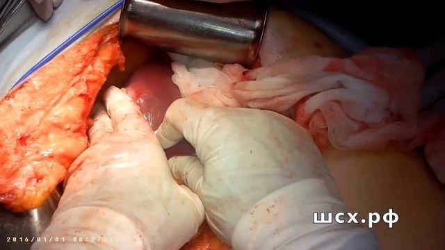 Билобарные метастазы