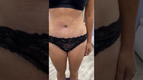 Результат абдоминопластики