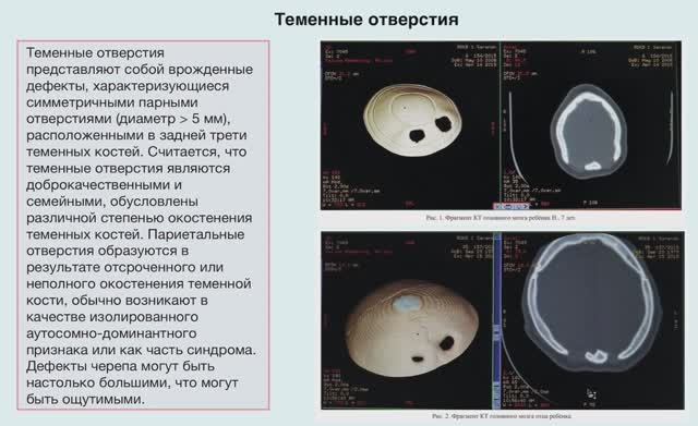 Видеоурок. Пороки развития костей мозгового отдела черепа