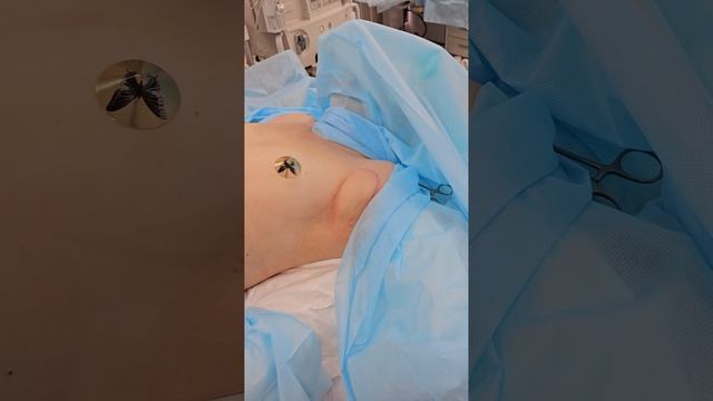 Липосакция подмышек