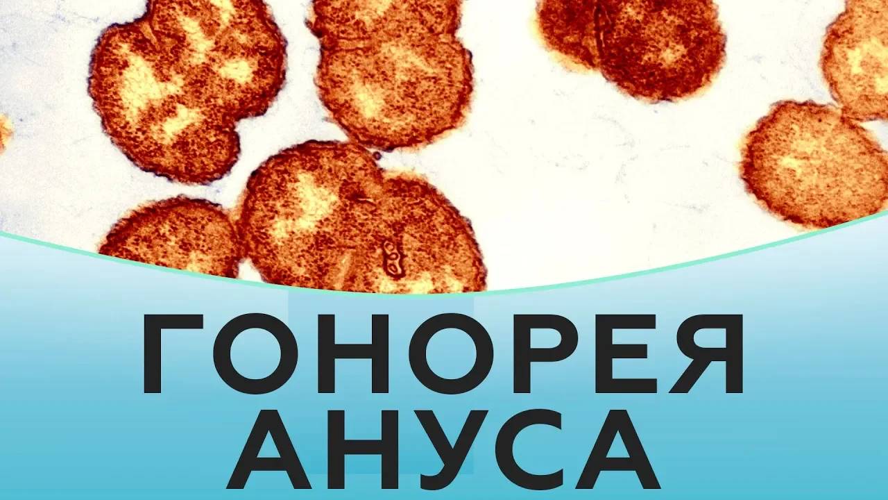 Гонорея ануса. Как лечить гонорею ануса. Лечение гонореи ануса