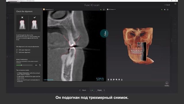 Объединение внутриротовых и 3D-рентгеновских снимков Функция SmartFusion