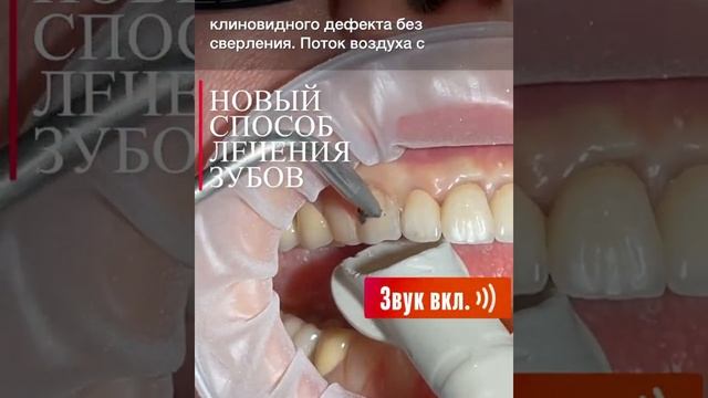 новый метод лечения пришеечного кариеса.mp4