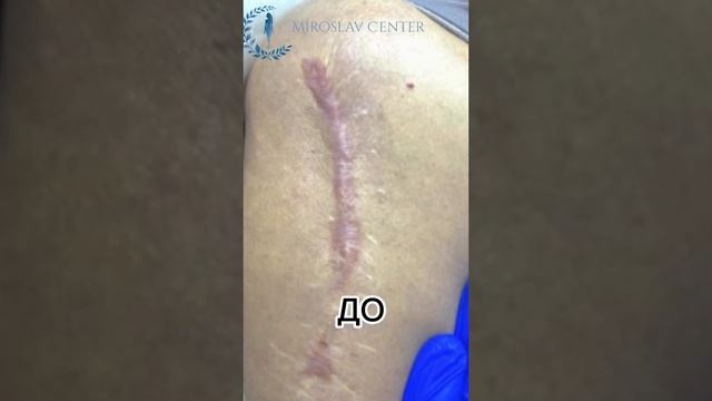 Плазма. Удаление рубцов.