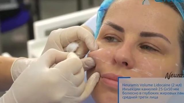 Филлер Neuramis Lidocaine  2Filler.ru