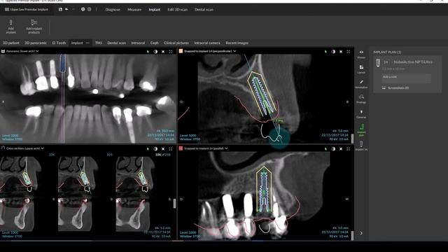 Планирование имплантации в DTX Studio Clinic и перенос плана в DTX Studio Implant