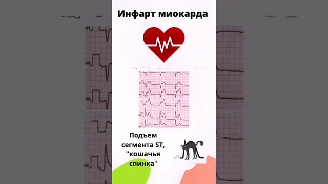 Экг