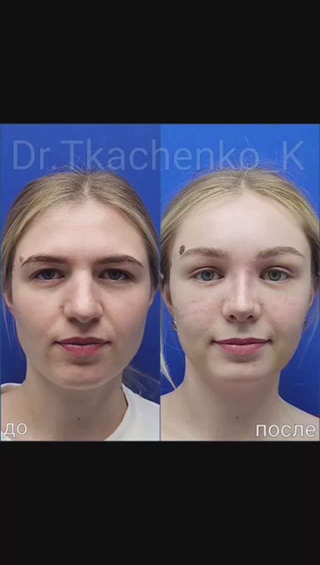 Эндоскопическая подтяжка лба и ринопластика.
12 дней после операции.