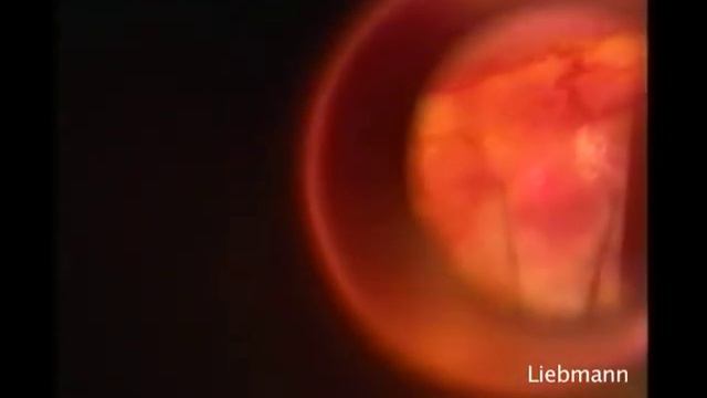 Laser Suture Lysis (LSL) after Trabeculectomy. Jeffrey Liebmann, MD